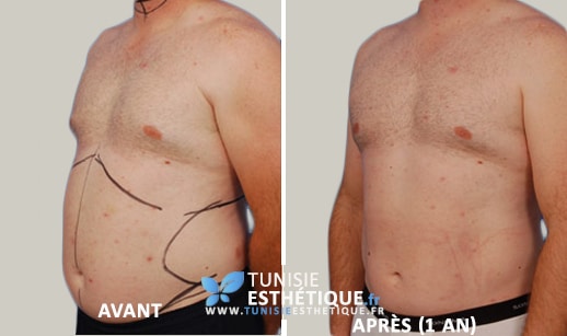 Liposuccion-ventre-homme-Tunisie-Esthetique-Avant-Apres3