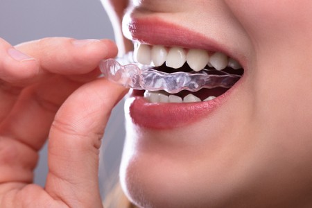 Orthodontie invisible tunisie esthetique photo 1