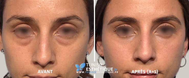 Blepharoplastie avant apres 1