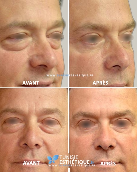 blepharoplastie tunisie avant apres 3