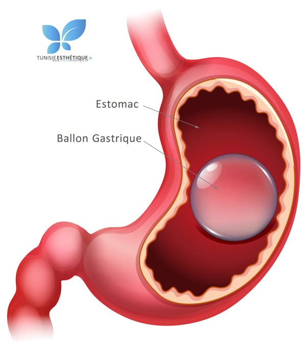 schema explique ballon gastrique Tunisie