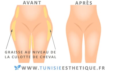 Comment éliminer la culotte de cheval?