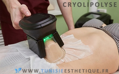 Cryolipolyse: différence avec liposuccion