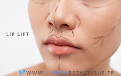 Lip Lift sur visage d'une femme