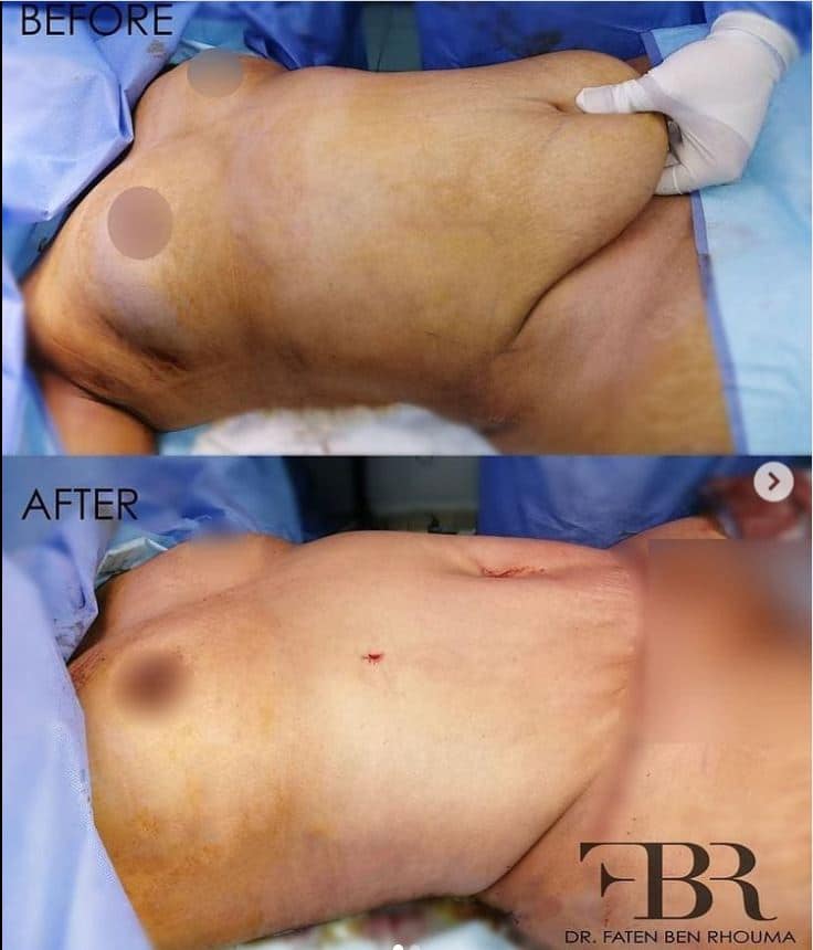 abdominoplastie Tunisie par dr Faten Ben Rhouma