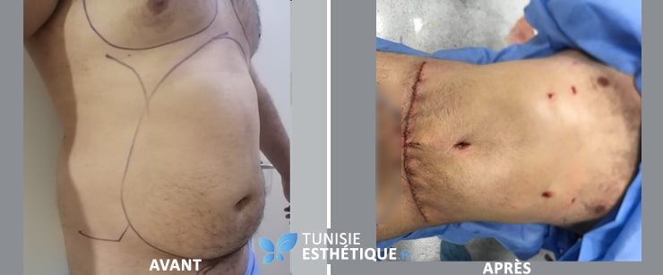 abdominoplastie tunisie homme par dr ben rhouma