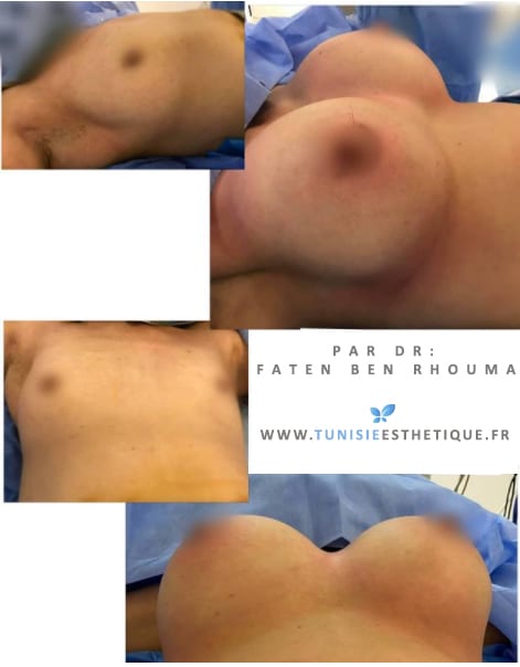 Augmentation mammaire par prothese en Tunisie par Dr Faten Ben Rhouma