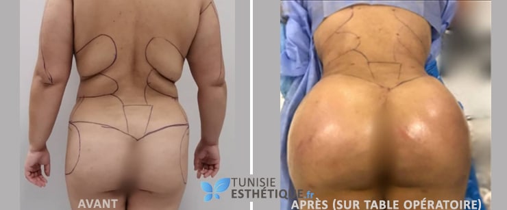 Liposuccion et lipofilling fesse dr faten ben rhouma