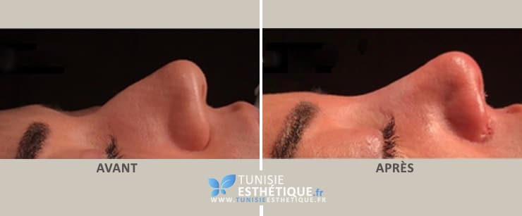 Photo avant apres rhinoplastie Tunisie par Dr Ben Jemaa