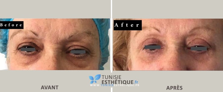 Blepharoplastie Tunisie Dr Ben Jemaa