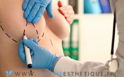 Augmentation mammaire : prothèses ou injections ?