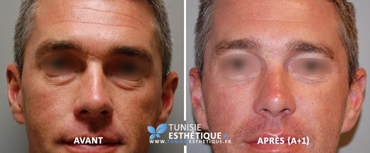 blepharoplastie avant apres