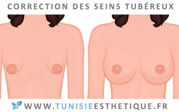 corriger des seins tubereux avant après