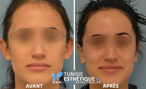 otoplastie avant après 