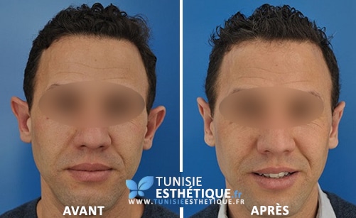 otoplastie avant après