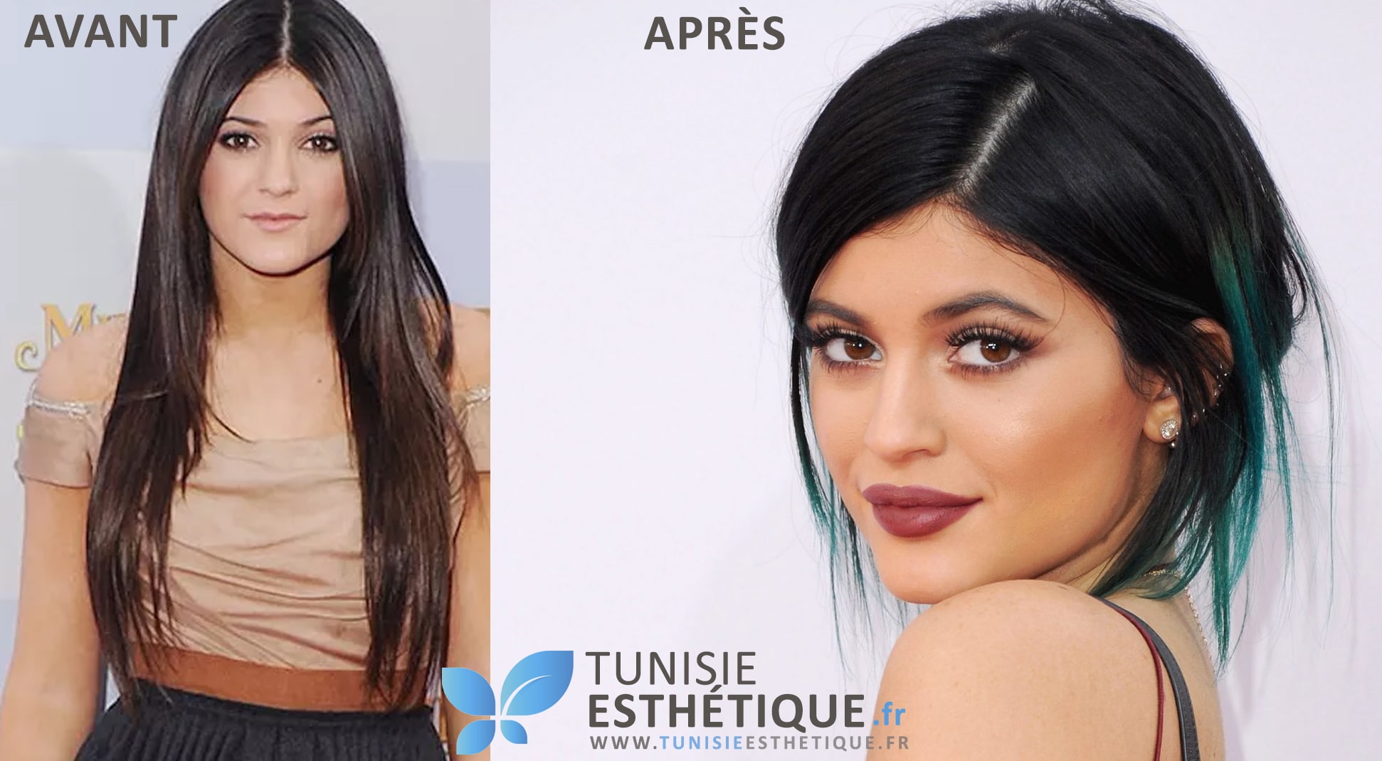 Kylie Jenner visage Avant Apres