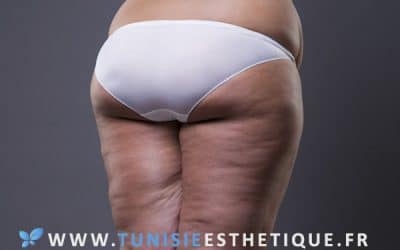 Lipoedème et traitements