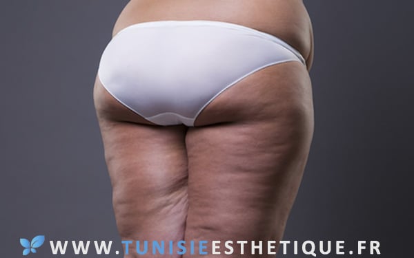 Lipoedème et traitements - Tunisie Esthetique