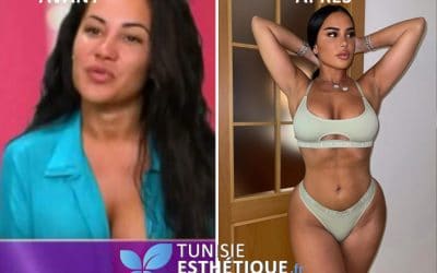 Milla Jasmine avant et après sa chirurgie esthétique