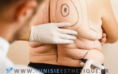 Quand faire une liposuccion ?