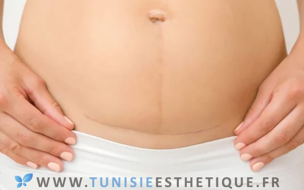 femme presentant une cicatrice horizontale et verticale abdominoplastie