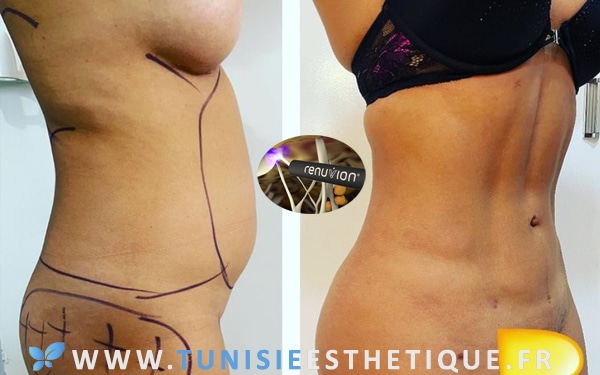 Renuvion J-Plasma : pour une liposuccion sans relâchement de peau