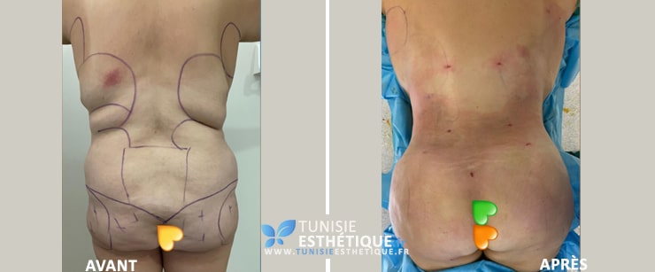 Liposuccion et lipofilling des fesses par Dr Ben Rhouma