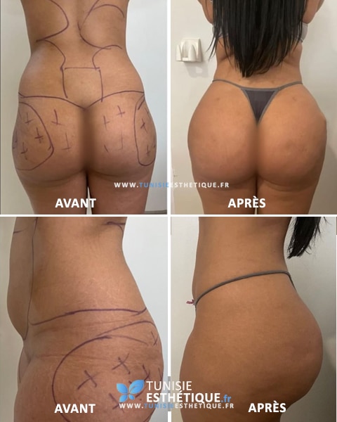 Liposuccion et lipofilling des fesses par Dr Faten Ben Rhouma en Tunisie