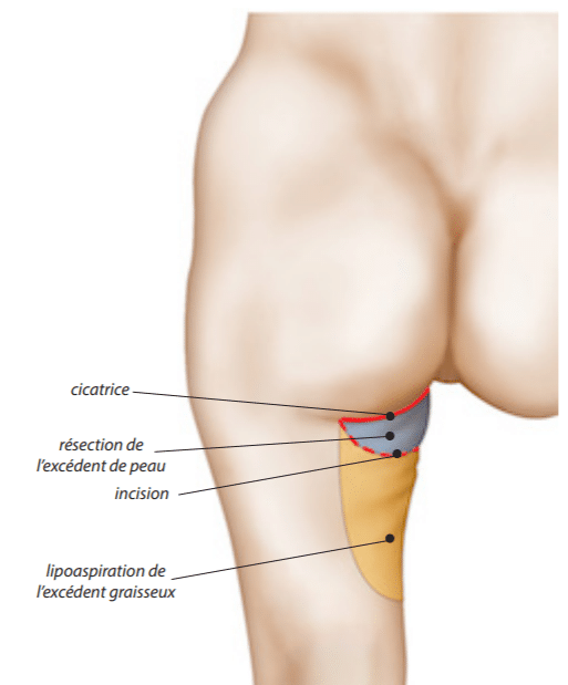 Lifting des cuisses avec cicatrice horizontale