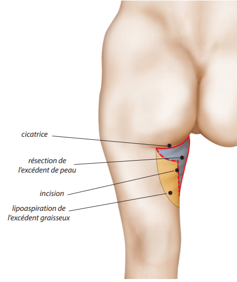 Lifting des cuisse avec cicatrice en T