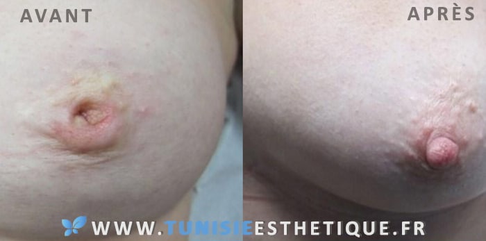 mamelon ombilique avant et apres chirurgie en Tunisie