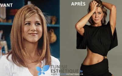 Les acteurs de Friends avant et après la chirurgie esthétique