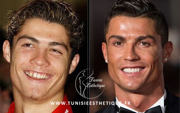 Cristiano Ronaldo avant la chirurgie