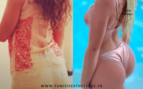 Eva Ducci avant et après chirurgie
