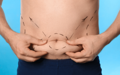 Le guide pour une liposuccion du ventre réussie en 2025