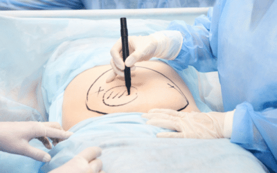 Liposuccion pas cher : Top 5 destinations à considérer en 2025