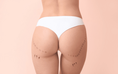 Le Brazilian Butt Lift (BBL) : tout ce que vous devez savoir
